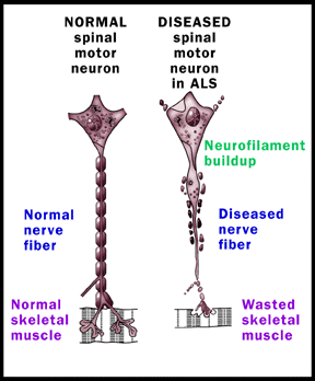 [illustrations of normal and diseased spinal motor neurons]