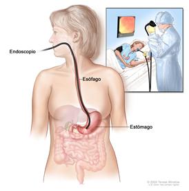 Endoscopia superior; muestra un endoscopio insertado a través de la boca y el esófago hacia el estómago. El recuadro muestra al paciente en una camilla haciéndose una endoscopia superior.