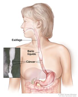 Ingestión de bario; muestra bario líquido bajando por el esófago hacia el estómago.
