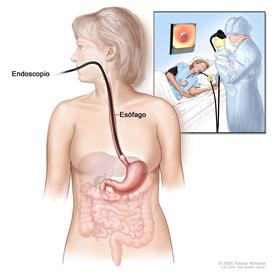 Esofagoscopia; muestra un endoscopio insertado a través de la boca hacia el esófago. El recuadro muestra al paciente en una camilla haciéndose la esofagoscopia.