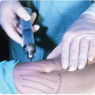 Close-up photo of surgeon's gloved hands performing liposuction by inserting large needle into a patient's abdomen which is circled with a purple marker.