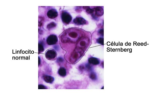 Célula de Reed-Sternberg; la fotografía muestra los linfocitos normales comparados con una célula de Reed-Sternberg.