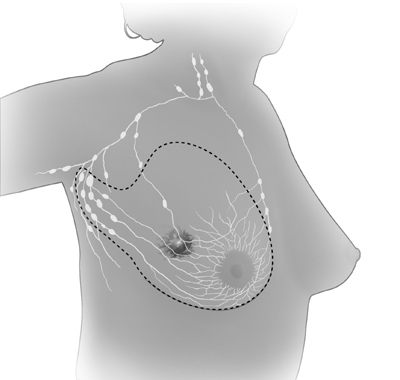 In modified radical mastectomy, the surgeon removes the whole breast, and most or all of the lymph nodes under the arm.  Often, the lining over the chest muscles is removed.  A small chest muscle also may be taken out to make it easier to remove the lymph nodes.