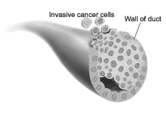 This picture shows cancer cells spreading outside the duct.  The cancer cells are invading nearby tissue inside the breast.