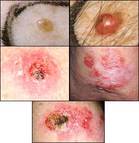 Skin changes that could indicate skin cancer. - Click to enlarge in new window.