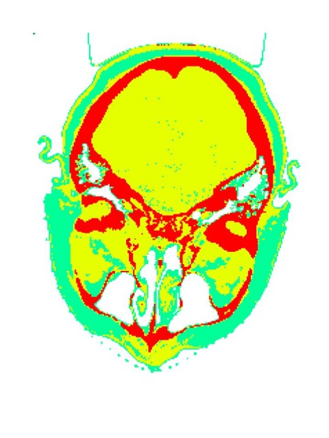 Acuros calculated dose field and CT image for a head and neck treatment.