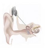 Cochlear implant. - Click to enlarge in new window.
