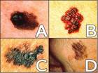 Photos showing examples of melanomas. - Click to enlarge in new window.