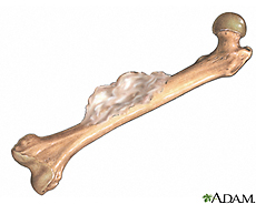 Ilustración del osteosarcoma