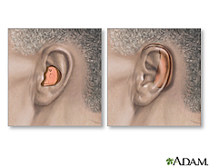 Ilustración de dos tipos de audífonos