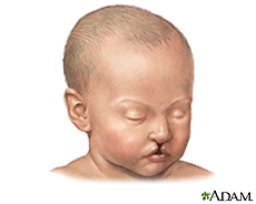Ilustración de un bebé con el labio hendido