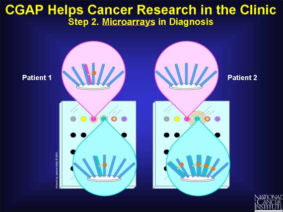 CGAP Helps Cancer Research in the Clinic: Step 2. Microarrays in Diagnosis