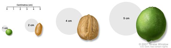 Comparación del tamaño del tumor con objetos cotidianos; muestra varias medidas de un tumor comparadas con un frijol, maní, nuez y limón