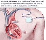 Cardiac Pacemaker Implanted Illustration