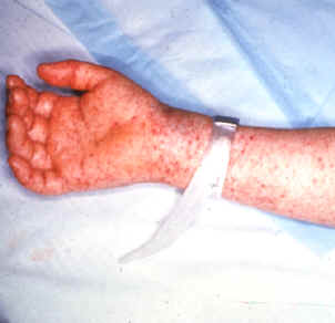 Picture- Late (petechial) rash on palm of hand and forearm