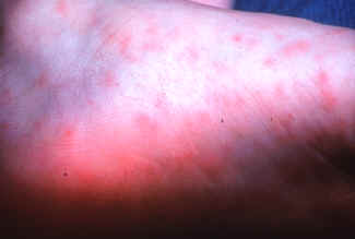 Picture- Early (macular) rash on sole of foot