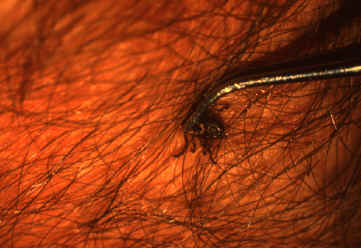 Picture- tick being removed from human skin