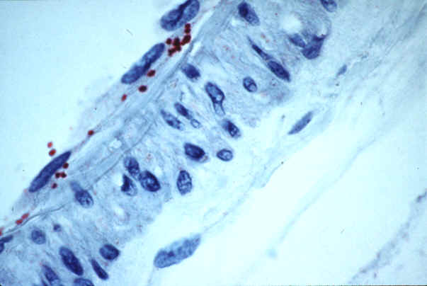 Picture- Immunohistochemical stain of Rickettsia rickettsii in endothelial cells of a blood vessel