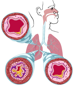 Illustration demonstrating the effect of NF-kB on airway remodeling.