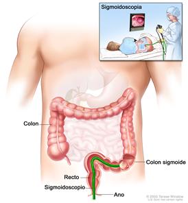 Sigmoidoscopia; muestra un sigmoidoscopio que se inserta a través del ano y el recto hacia el colon sigmoide.  El recuadro interior muestra la imagen de un paciente en camilla al que se le realiza una sigmoidoscopía.