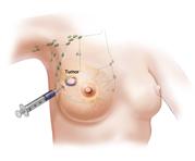 Sentinel lymph node biopsy.  First of three panel illustration showing radioactive substance and/or blue dye is injected near the tumor, the injected material is followed visually or with a probe, and the first lymph nodes to take up the material are removed and checked for cancer cells.