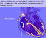 Cardiac Ablation Catheter Illustration
