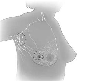 Cirugía preservadora de mama; el dibujo muestra la extirpación del tumor y los ganglios linfáticos axiliares.