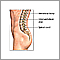 Fusión espinal (fijación de la columna vertebral)  - Procedimientos