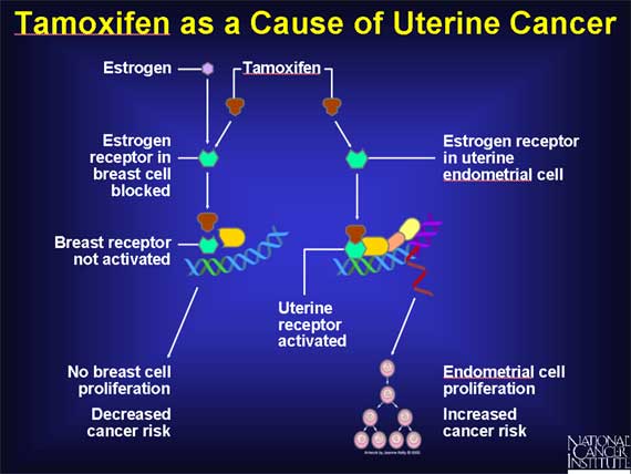 Tamoxifen as a Cause of Uterine Cancer