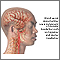 Cefaleas vasculares