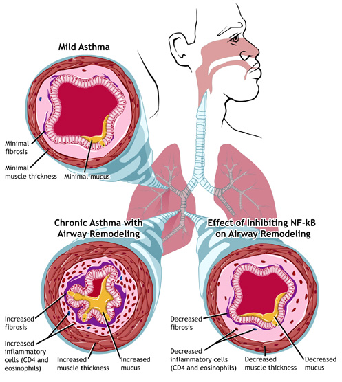 Illustration demonstrating the effect of NF-κB on airway remodeling