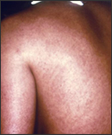 This posterior-oblique view of a female Marburg patient’s back (case #2), depicts a measles-like rash, which is a usual symptom of this viral illness.