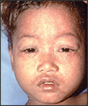 Face of child with measles.