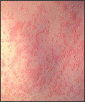 This is the skin of a patient after 3 days of measles infection.