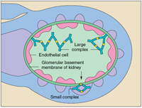 Large and small antigen-antibody complexes trapped in the glomerular basement membrane of a kidney, between endothemelial cells.