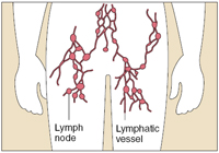 An image of lymph nodes interconnected by lymphatic vessels in the body.