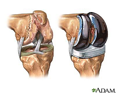 Ilustración de la articulación de la rodilla antes y después de un reemplazo con prótesis