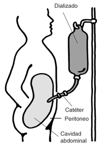 La ilustración de una persona para se tratar con el diálisis de peritoneal