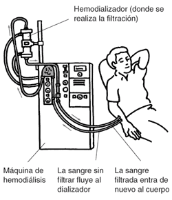 La ilustración de un hombre para se tratar con hemodialysis