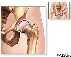 Ilustración de la articulación de la cadera