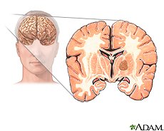 Ilustración de un tumor cerebral