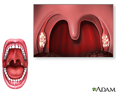 Ilustración de la garganta mostrando síntomas de faringitis estreptocócica