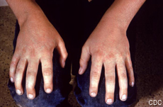 Fotografía de unas manos rojas y sarpullidas por la quinta enfermedad