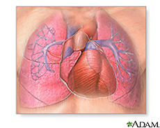 Ilustración demostrando el estrechamiento de las arteriolas pulmonares y el ventrículo derecho agrandado
