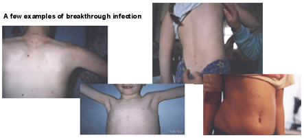 A few examples of breakthrough infection