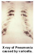 X-ray of Pneumonia caused by varicella