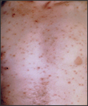 This patient with chickenpox developed lesions on the skin of his chest and torso.