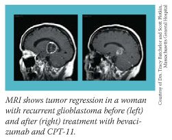 MRI shows tumor regression in a woman with recurrent glioblastoma before (left) and after (right) treatment with bevacizumab and CPT-11.