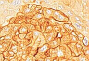 Transforming growth factor-alpha on cell surface of hepatocytes in prenoeplastic focus (polyclonal antibody to pro-form). photograph.