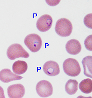 Blood smear taken from Ms. Jones in the Emergency Room and examined under the microscope, showing that many of the red blood cells are infected with the malaria parasite Plasmodium falciparum.